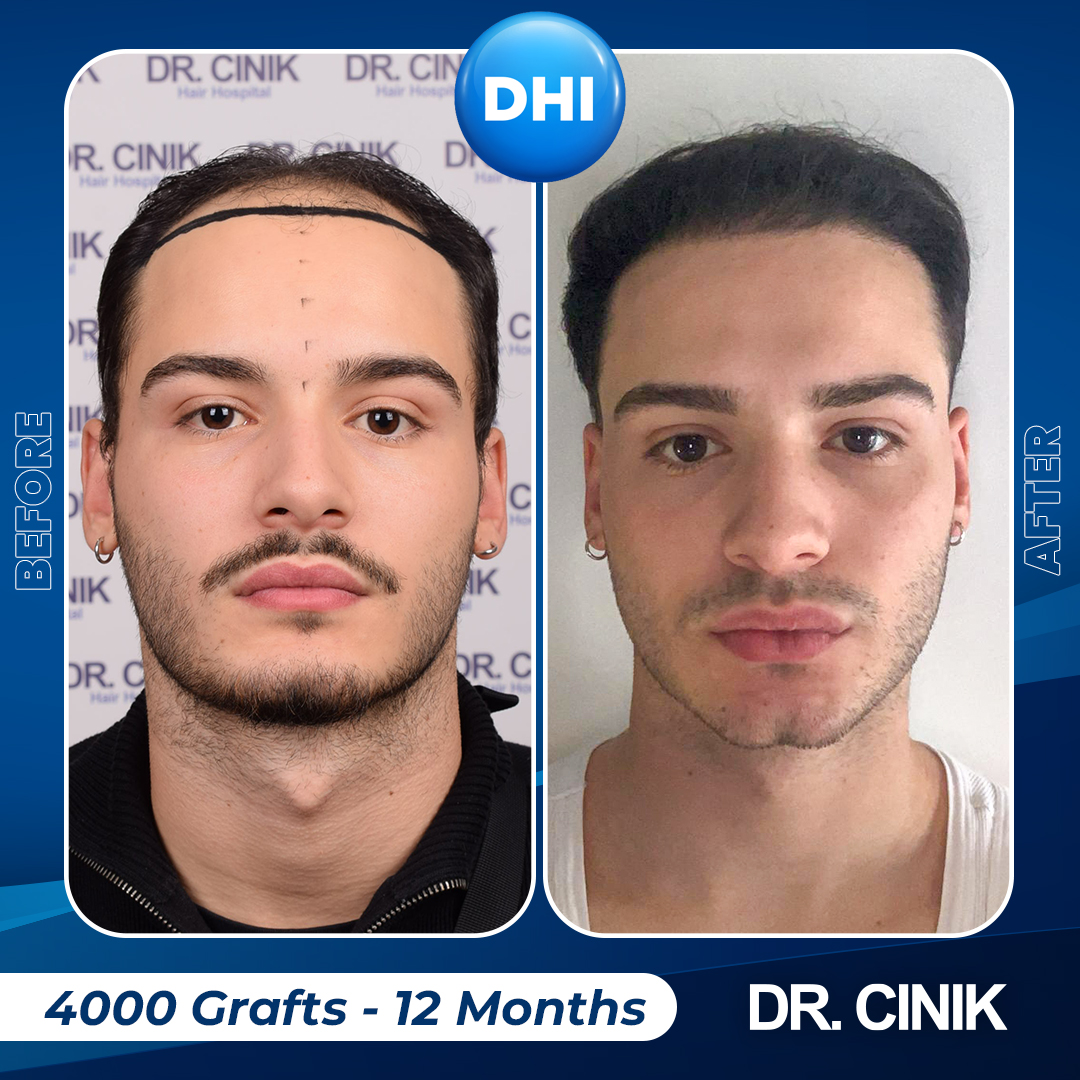 drcinikofficial's tweet image. 🌟 Amazing transformation alert! After 12 months and 4000 #grafts using the #DHI method, look at these incredible results from #DrCinik. We're transforming lives, one hair at a time💪

📞 +90 549 641 37 01 | 🌐 drcinik.com

#HairTransplant  #DHI #TransformationTuesday