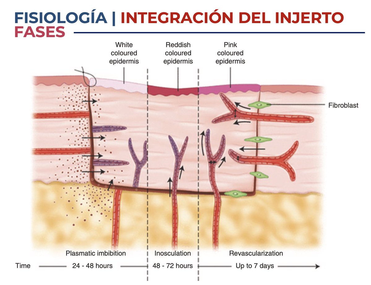 Fases de la Integración de un Injerto⬇️

1️⃣Imbibición Plasmática (24 a 48 horas)
2️⃣Inosculación (48-72 horas)
3️⃣Revascularización (Hasta 7 días)

#SoMe4PedSurg #UroSoMe #PedsUro #Hypospadias #Graft #plasticsurgery #recon #UroRecon