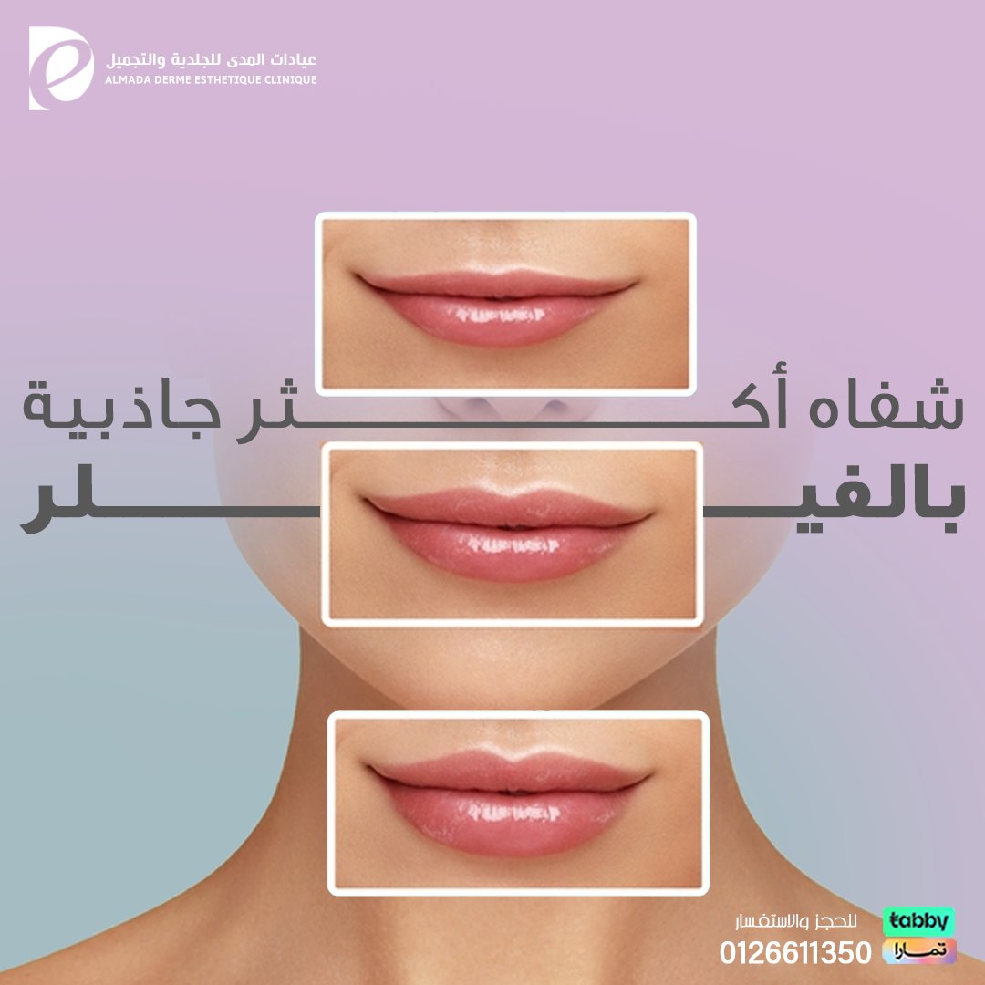 almada_clinics's tweet photo. ابرزي جمال شفاهك
مع أفضل الأطباء المتخصصين في عيادة المدى،
تواصلي معنا الان واستمتعي بجمال لا يضاهى في الصيف: 0126611350
#عيادات_جدة #عيادت_تجميل #فيلر #بوتكس #عيادات_المدى_للجلدية_والتجميل
#فيلر_شفايف
#جدة #مكة #jeddah #الطايف
#عروض_تجميل #خيوط_تجميلية #نتائج_الخيوط #زيدي_جمالا https://t.co/3LrxpwLMIu