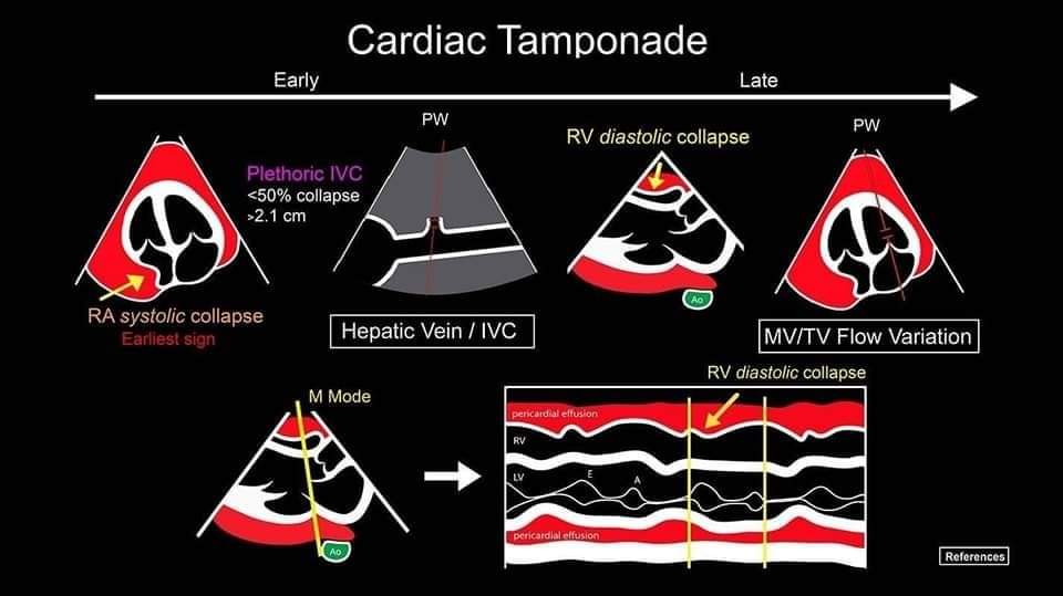 ZHeart11768530's tweet photo. 🔴 Cardiac Tamponade: Echocardiographic Evaluation

🔹https://t.co/J3lEr99yG2
#cardiology #CardioTwitter #CardioEd #MedEd #criticalcare #clinical #clinic #anesthesiology https://t.co/vE0MMm2a9w