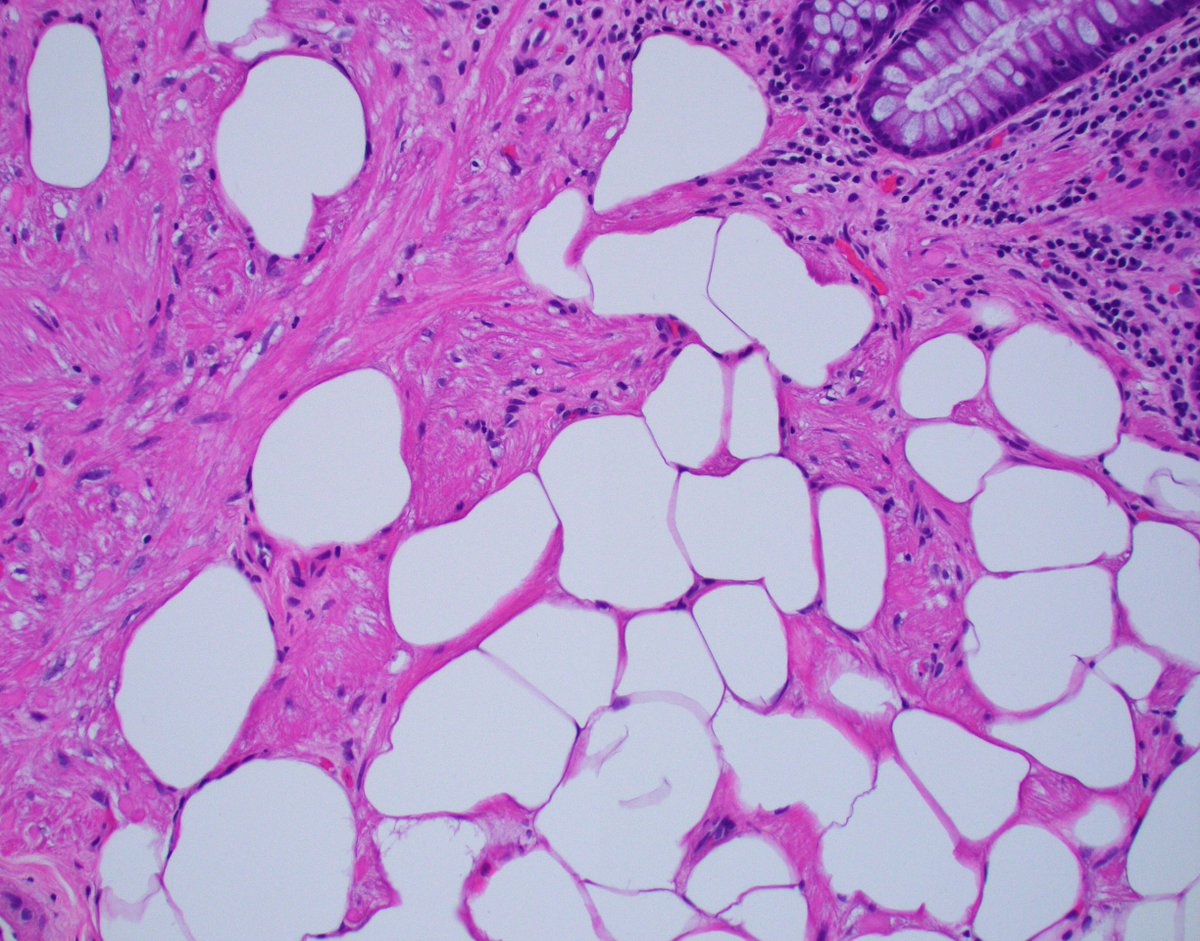 A rare find: Liopleiomyoma of the colon. Consisting of benign smooth muscle and adipose tissue, this variant of leiomyoma highlights the fascinating diversity within pathology. #SurgPath #GIPath #PathBoards #Histopathology #PathologyCases #PathTweetorial #pathx #pathtwitter