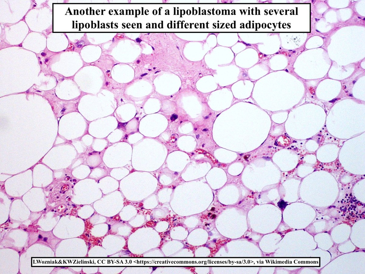 Lipoblastoma

•Benign neoplasm of embryonal white fat
•May be local or diffuse (lipoblastomatosis)
•75-90% occur<3y/o
•Trunk+extremities are most common sites
•Size usually 2-5 cm
•🔬lobulated; adipocytes w/ variable maturation; separated by fibrovascular septae 
•🧬PLAG1