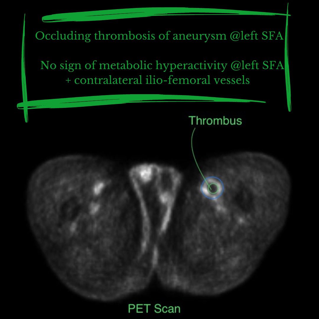 AngioUpdates's tweet photo. #thromboinflammation https://t.co/xWpVnC8mG0