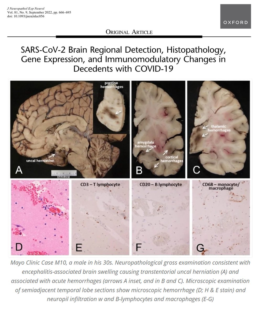 Let's call it a respiratory virus, what can possibly go wrong?
Everything. 
Covid is systemic.
#neuroCovid