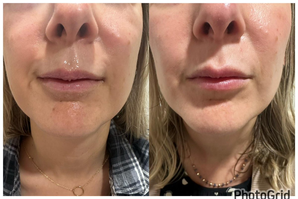 Evolvedyou_'s tweet image. 💫 Transform your look in no time with Evolutions Medspa&apos;s neuromodulator and filler treatments. Book your consultation now! 💫 #QuickTransformation #MedSpaResults #BeforeAndAfter #EvolutionsMedspa. 314-834-6004. booking.evolvedyou.co. 9911 Kennerly Rd, Ste C, St. Louis, MO