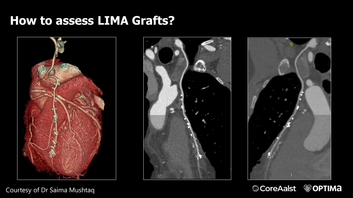 Dr Dan Jones and Dr Daniele Andreini take the stage 🎤 #CTCourse - After CABG: never again performing an angiogram without CT!

@bernardBruyne <a href="/ColletCarlos/">Carlos Collet MD PhD</a> <a href="/OptimaCTO/">Optima Education</a> <a href="/CardioAalst/">Hartcentrum Aalst</a> <a href="/Bhcintervention/">Dan Jones</a> <a href="/DAndreiniMD/">Daniele Andreini</a> <a href="/jcspratt/">jcspratt</a> <a href="/OLVZaalst/">OLV Ziekenhuis</a> <a href="/ziadalinyc/">Ziad Ali</a> <a href="/DrNataliaP/">Natalia Pinilla</a> <a href="/hect2701/">Prof. Hector M. Garcia-Garcia</a> @jeroen_sonck