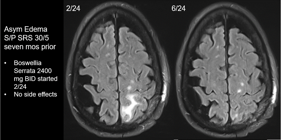 My 1st patient on Boswellia Serrata…
appliedradiationoncology.com/articles/role-…