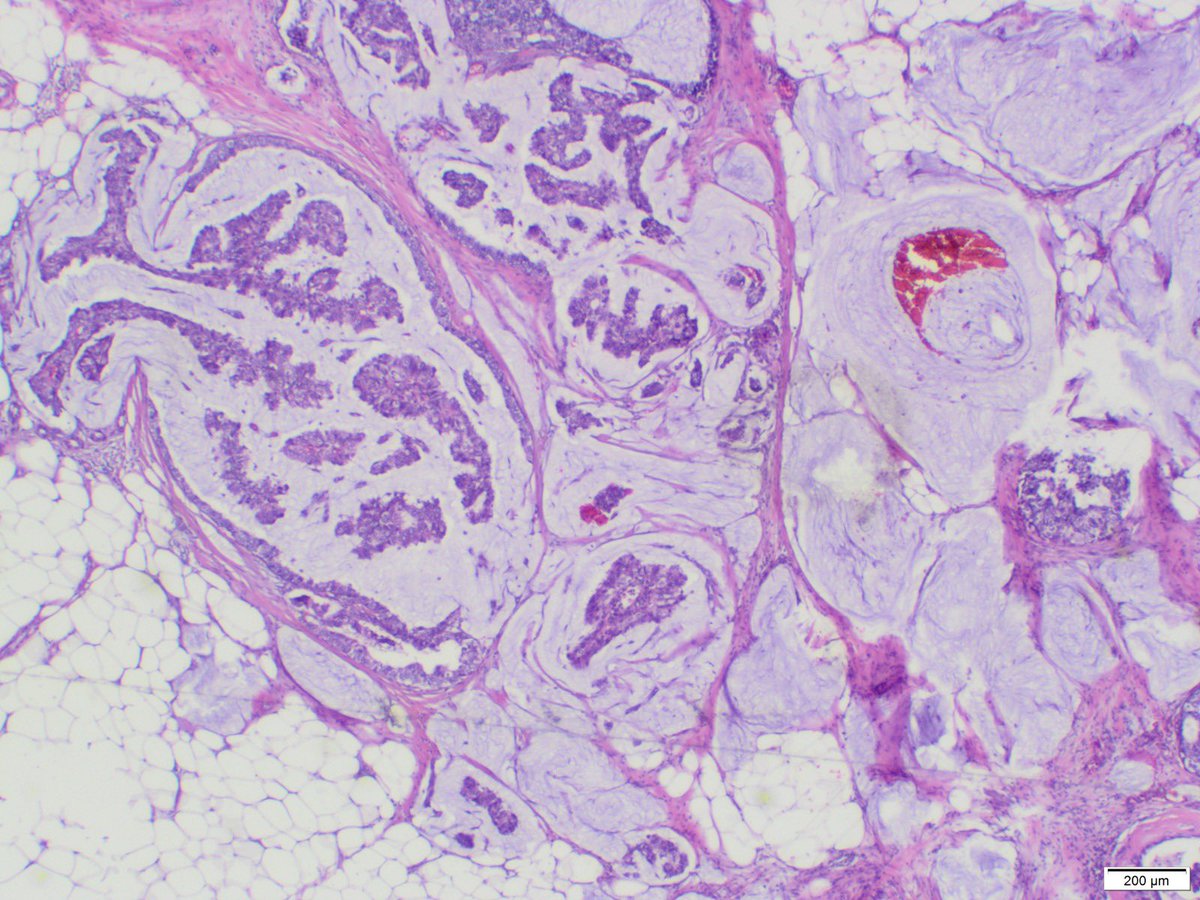 sbakhsh2's tweet photo. 32y 👧Papillary DCIS&amp;Invasive mucinous Ca https://t.co/f6H3zW8vrm
