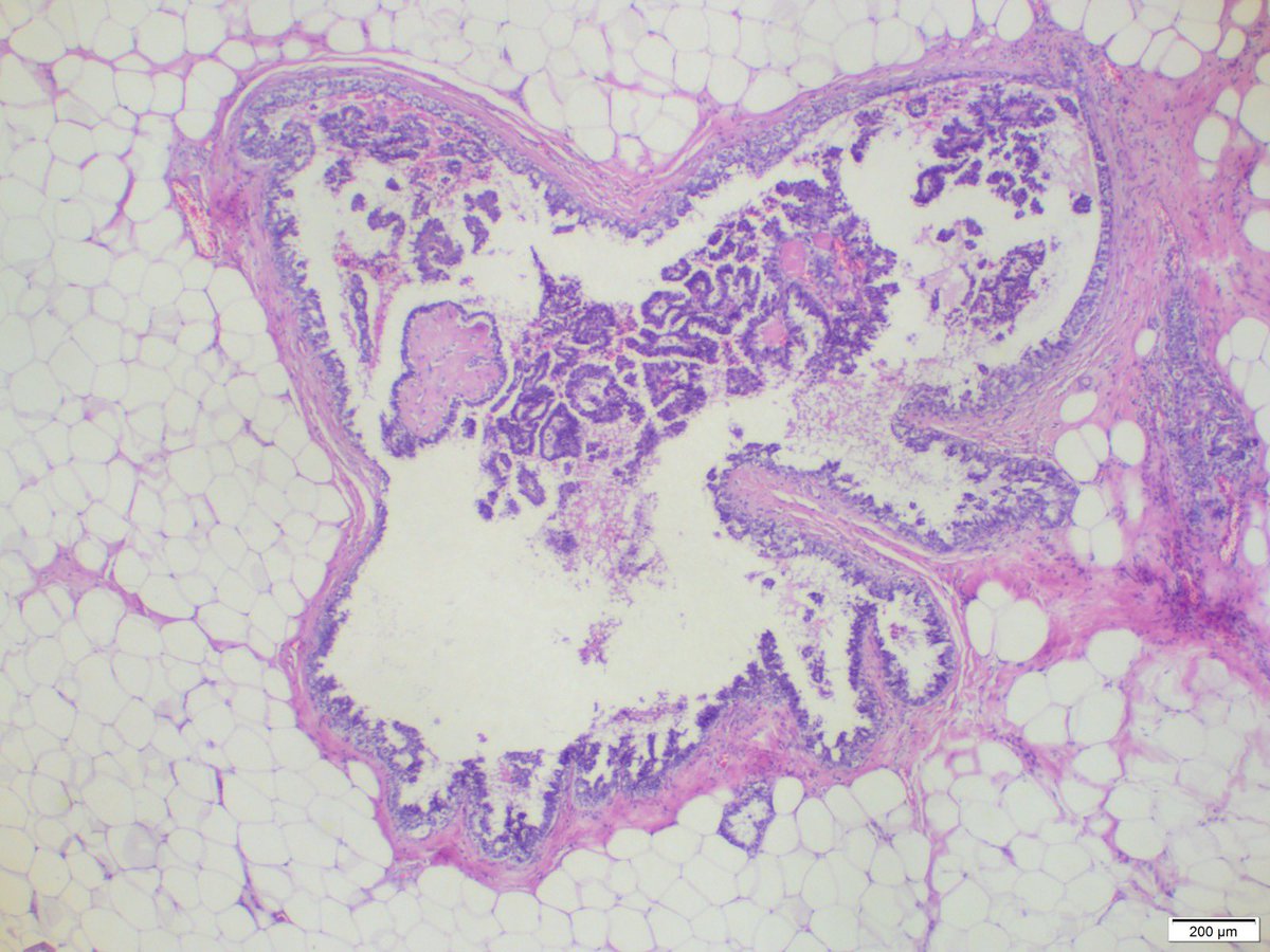 sbakhsh2's tweet photo. 32y 👧Papillary DCIS&amp;Invasive mucinous Ca https://t.co/f6H3zW8vrm
