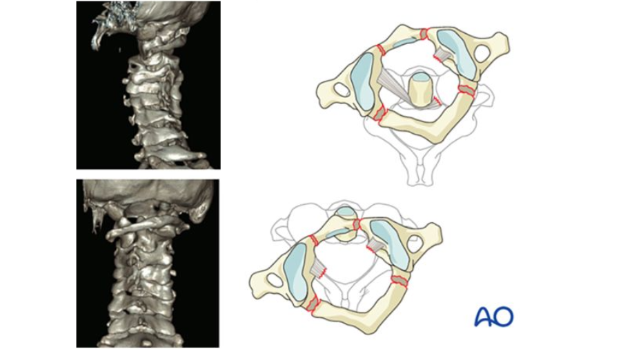 The AO Surgery Reference Spine Occipitocervical trauma module has been updated with the AO Spine Upper Cervical Injury Classification System!
Celebrate with Cumhur Öner &amp; Luiz Vialle, use the new content, and speak the global language of spine surgeons 👉 brnw.ch/21wKX8q