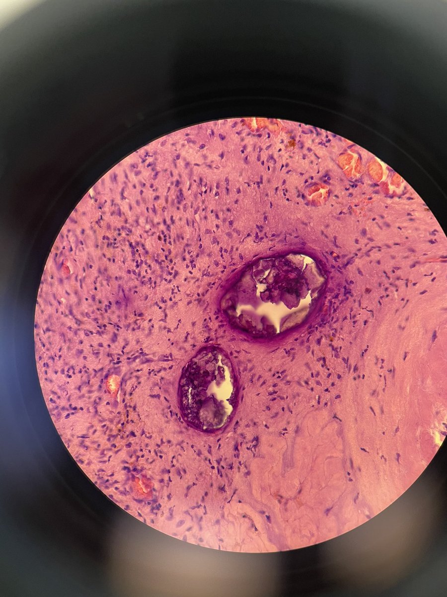 These huge multinucleated giant cells, more characteristic of de quervain's thyroiditis than for PTC, ate most of the PTC tumor cells (BRAF V600E+), so we hardly found these few cells and psammomous bodies in histology. #cytopath