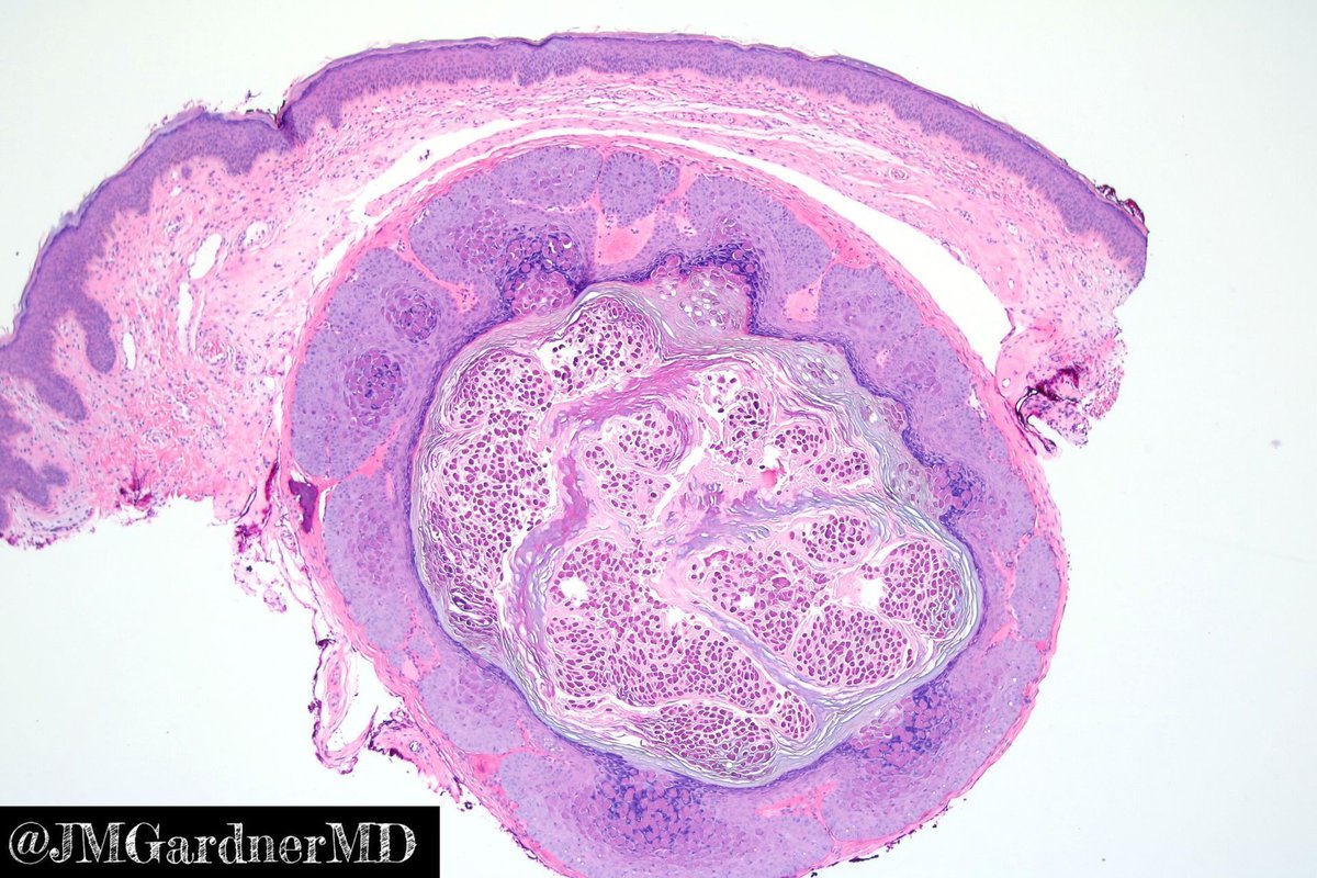 Cyst from the thigh of a child. Your diagnosis? Answer here: youtu.be/APVCziUvL2g?si…. #pathology #pathologists #pathTwitter #dermpath #dermatology #dermatologia #dermtwitter