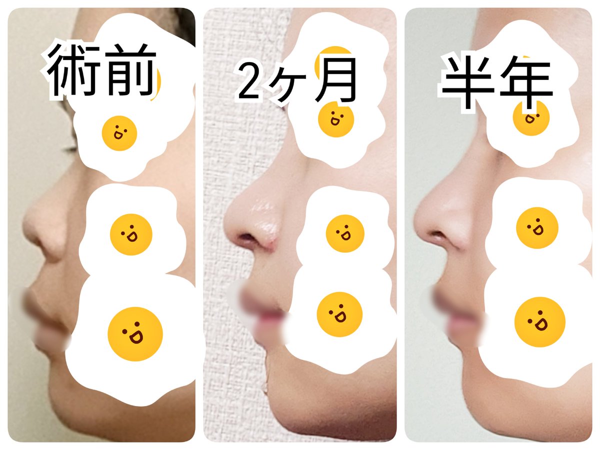 c_outface's tweet photo. 🙌鼻フルから半年経過🙌
鼻の腫れと違和感が完全に落ち着いて、術後に一番ネックに感じていた重みがなくなった🥳
2ヶ月目はまだ丸かった鼻先が半年経って重心が下に降りてきたのかナチュラルになった気がする🥳
小鼻縮小で鼻の横幅が3.5cm→3cmになって、鼻先が伸びたことで人中も短くなって嬉しい🥳 https://t.co/l5jBus1fjP