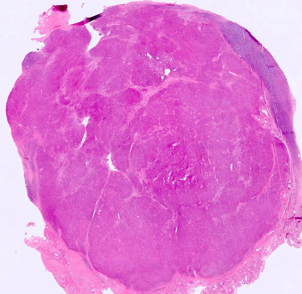 Ovary - what's your diagnosis?

Topic link: pathologyoutlines.com/topic/ovarytum…

Images contributed by Fatemeh Ghazanfari Amlashi, M.D., Tamara Kalir, M.D., Ph.D., and AFIP 

(See thread below for additional image)

#Cancer #CancerResearch #CuringCancerNetwork #Pathology
