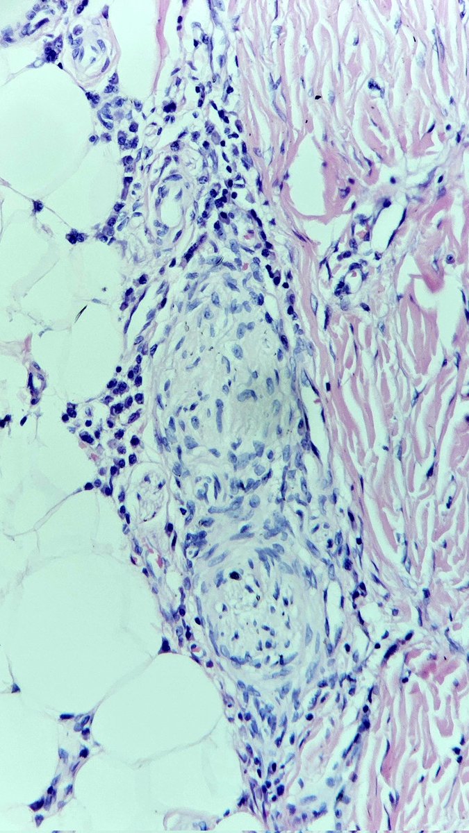 RobledoRochaMD's tweet photo. Plasma cell perineural inflammation, lymphoplasmacytic nodules at the juntion between reticular dermis and subcutaneous fat that is straight rather than jagged. These are some clues for morphea (localized scleroderma). https://t.co/30ihob8TKQ