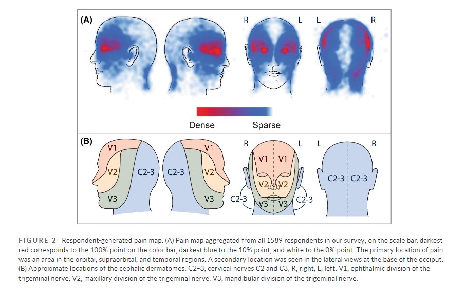 Headache Journal (@headachejournal) on Twitter photo Data from the International #ClusterHeadache Questionnaire finds most had pain beyond area of the eye, & the pain location did not correlate w autonomic symptoms, medication effectiveness, or other CH features
…adachejournal.onlinelibrary.wiley.com/doi/full/10.11…
<a href="/Hulin_Wu/">Hulin Wu</a> <a href="/dahdah_fares/">Farès el-Dahdah</a> <a href="/headachedoc/">Robert Shapiro</a> et al Data from the International #ClusterHeadache Questionnaire finds most had pain beyond area of the eye, & the pain location did not correlate w autonomic symptoms, medication effectiveness, or other CH features
…adachejournal.onlinelibrary.wiley.com/doi/full/10.11…
<a href="/Hulin_Wu/">Hulin Wu</a> <a href="/dahdah_fares/">Farès el-Dahdah</a> <a href="/headachedoc/">Robert Shapiro</a> et al