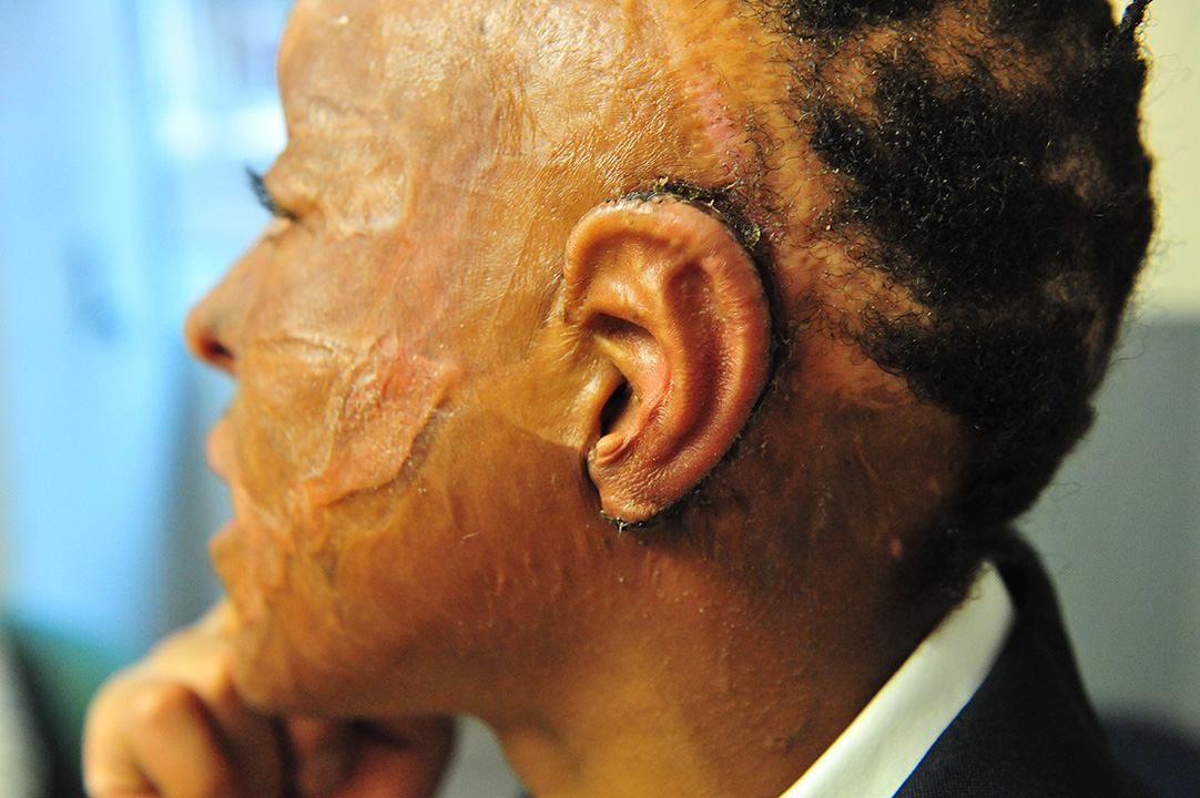 ChildrenOfFire's tweet photo. We know only 3 surgeons in the world who can rebuild a burned-away ear this well, with tissue expansion and rib-end cartilage, where none of the original ear remained. This was @GOSHCharity #eardamage #burnsurvivor #plasticsurgery https://t.co/cKU4OO3wIL