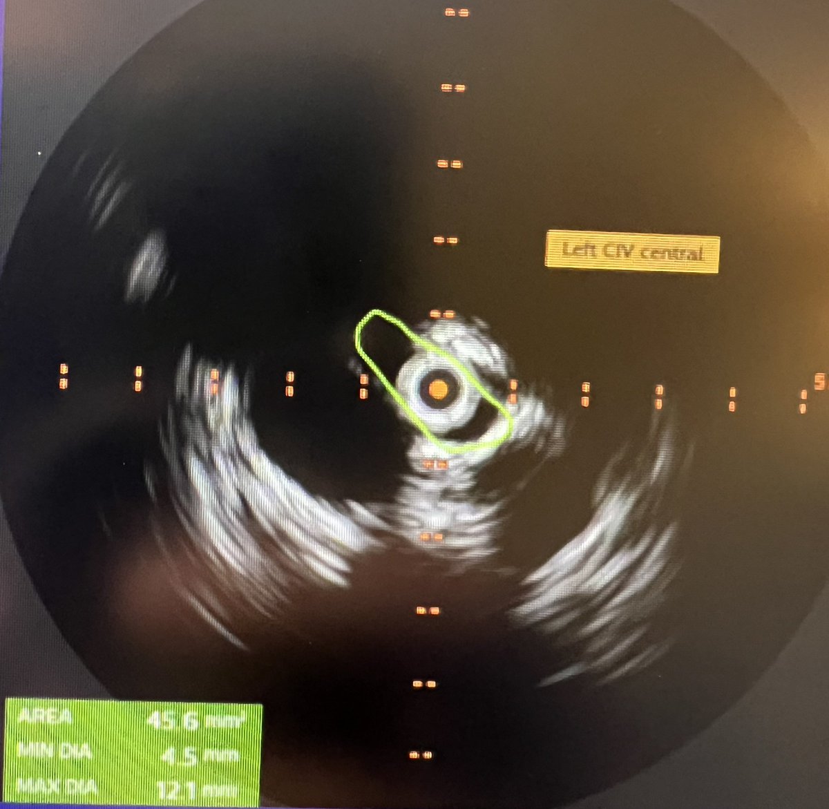 Ronald Winokur, MD, FSIR, FAVLS, RPVI (@ronaldwinokurmd) on Twitter photo Venous Origin Chronic Pelvic Pain (VO-CPP) can arise from reflux and/or obstruction as seen in this case example. Collecting data currently in a large way. Follow this link and help us with data collection weillcornell.az1.qualtrics.com/jfe/form/SV_3w…
<a href="/DrNeilKhilnani/">Neil Khilnani MD</a> <a href="/WeillCornell_IR/">Weill Cornell Medicine Interventional Radiology</a> Venous Origin Chronic Pelvic Pain (VO-CPP) can arise from reflux and/or obstruction as seen in this case example. Collecting data currently in a large way. Follow this link and help us with data collection weillcornell.az1.qualtrics.com/jfe/form/SV_3w…
<a href="/DrNeilKhilnani/">Neil Khilnani MD</a> <a href="/WeillCornell_IR/">Weill Cornell Medicine Interventional Radiology</a>