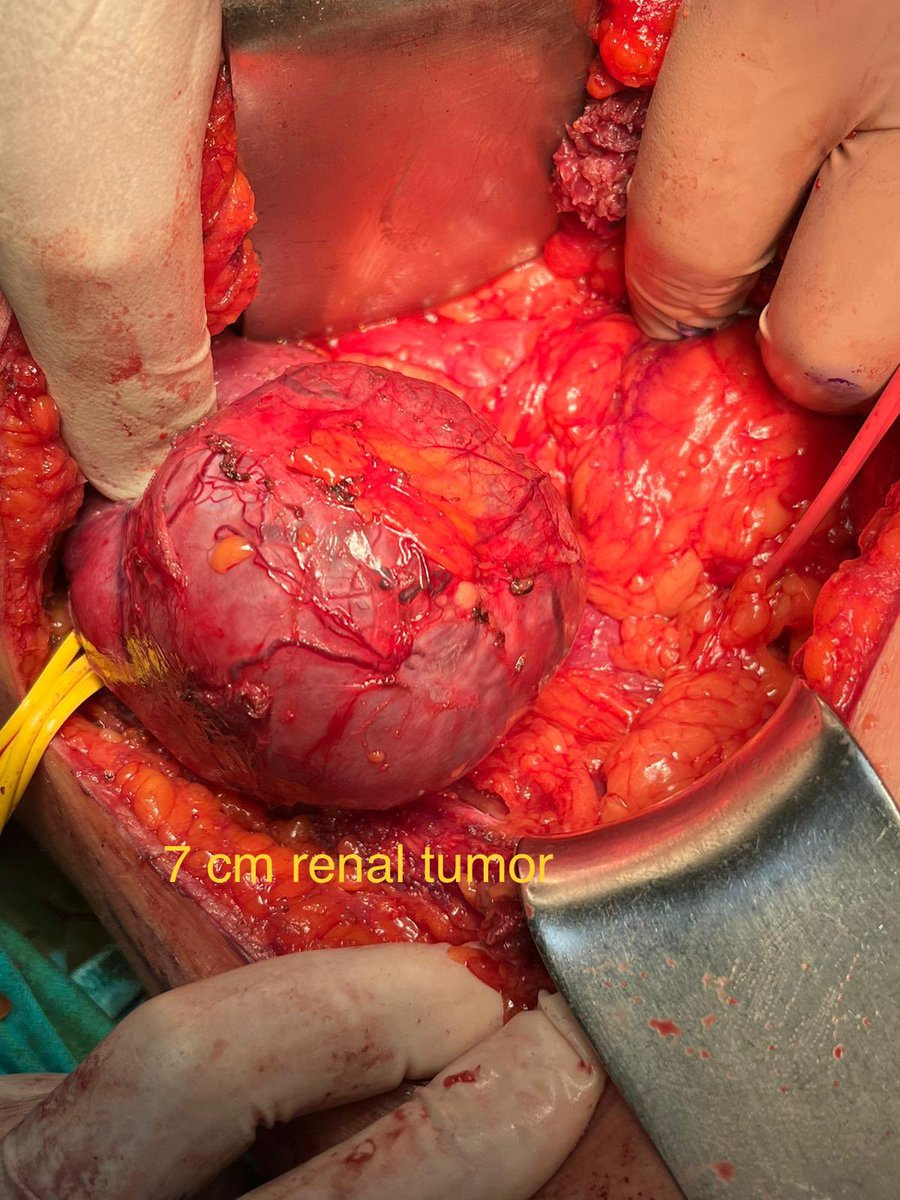 AcademicOner's tweet photo. Being a resident is not easy. The first image belongs to our resident @gurcanmehmet61 when he finally found the pedicle and isolated a 7 cm renal tumor just before starting excision #residentintraining #urology @tufantukek @istanbuledutr @istanbultipf @farukozcan1 @rifat_burak https://t.co/MNJIU374Gd