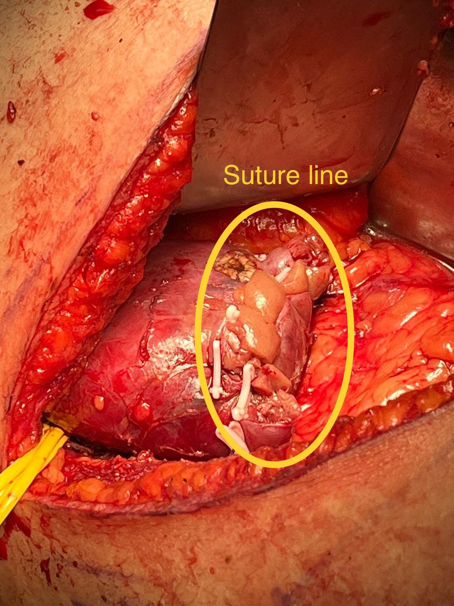 Oner Sanli Academic (@academiconer) on Twitter photo Being a resident is not easy. The first image belongs to our resident <a href="/gurcanmehmet61/">Mehmet Gürcan MD</a> when he finally found the pedicle and isolated a 7 cm renal tumor just before starting excision #residentintraining #urology <a href="/tufantukek/">Prof. Dr. Tufan Tükek</a> <a href="/istanbuledutr/">İÜ</a> <a href="/istanbultipf/">İstanbul Tıp Fakültesi</a> <a href="/farukozcan1/">Prof.Dr.Faruk Özcan</a> <a href="/rifat_burak/">Rifat Burak Ergül</a> Being a resident is not easy. The first image belongs to our resident <a href="/gurcanmehmet61/">Mehmet Gürcan MD</a> when he finally found the pedicle and isolated a 7 cm renal tumor just before starting excision #residentintraining #urology <a href="/tufantukek/">Prof. Dr. Tufan Tükek</a> <a href="/istanbuledutr/">İÜ</a> <a href="/istanbultipf/">İstanbul Tıp Fakültesi</a> <a href="/farukozcan1/">Prof.Dr.Faruk Özcan</a> <a href="/rifat_burak/">Rifat Burak Ergül</a>