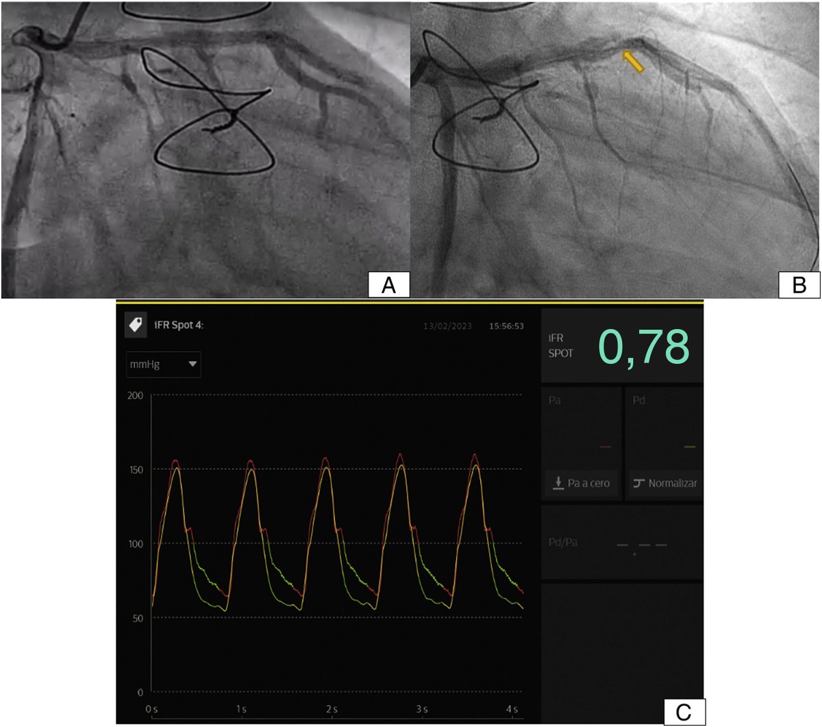 REC Publications (@revespcardiol) on Twitter photo Spontaneous coronary pseudoaneurysm following heart transplant #REC <a href="/JesusPeM17/">Jesús Peña Mellado</a> revespcardiol.org//en-spontaneou… Spontaneous coronary pseudoaneurysm following heart transplant #REC <a href="/JesusPeM17/">Jesús Peña Mellado</a> revespcardiol.org//en-spontaneou…