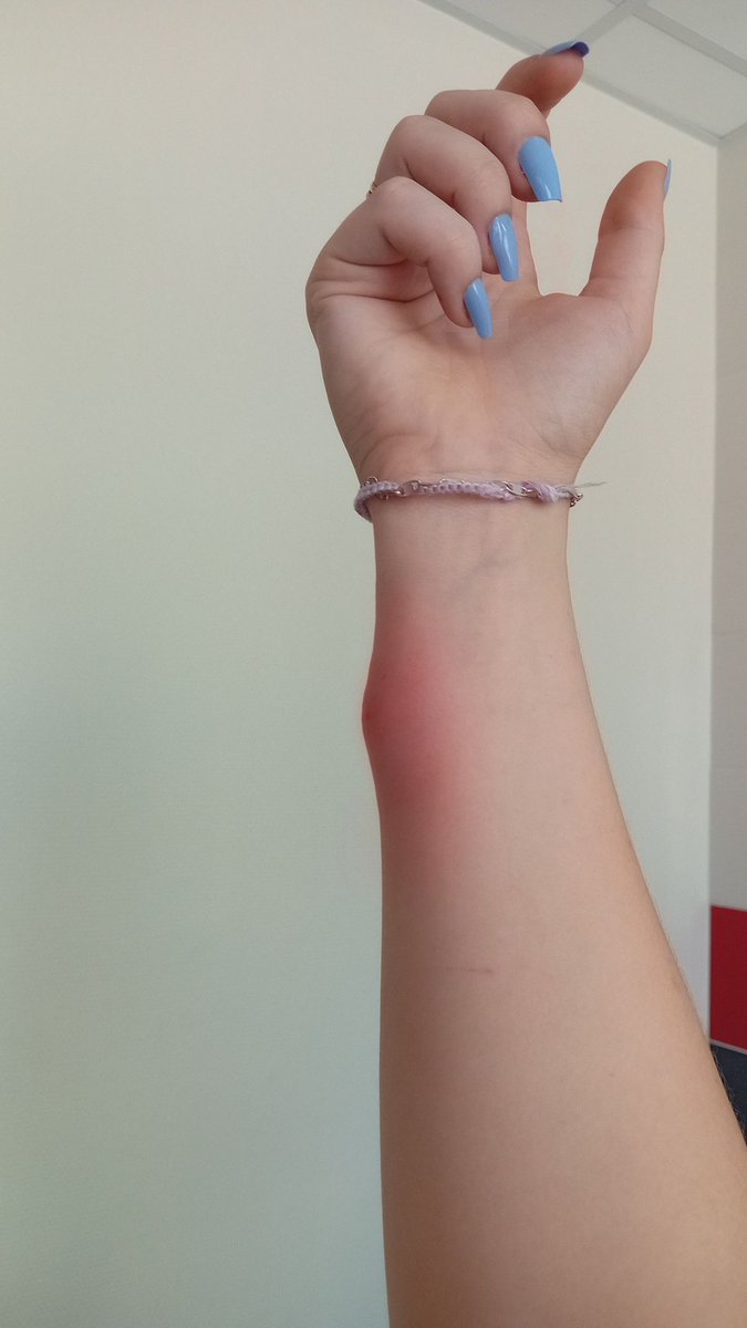 cephalalgie's tweet image. remerciez le ciel de pas être allergiques au moustiques