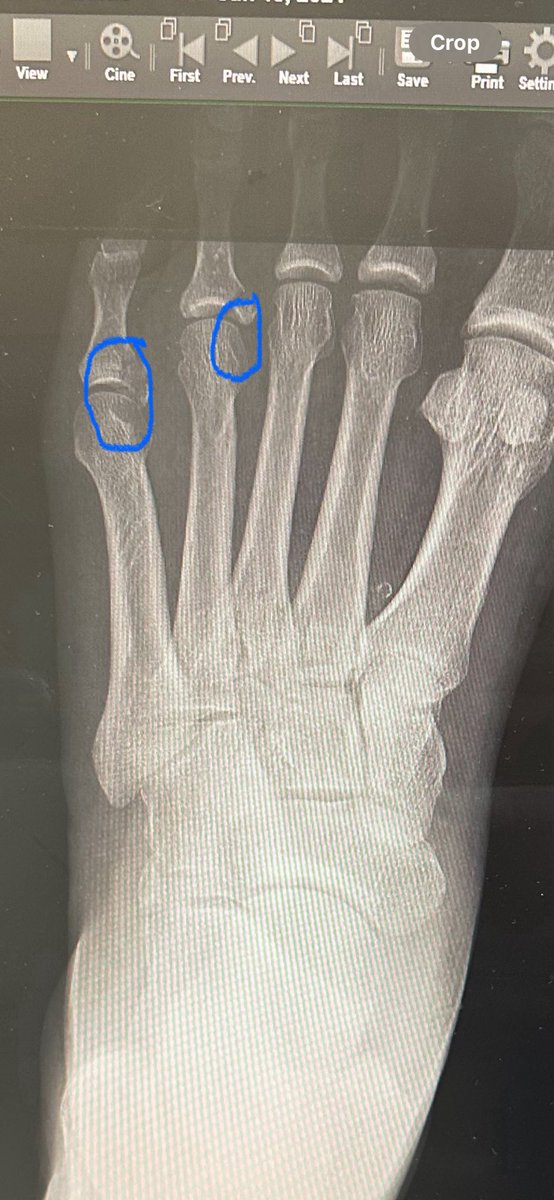 I’ll be glad when June 2024 is over.  During this month I lost the transmission in my chase car and broke 2 bones in my left foot.  Definitely on the sidelines for a month to 6 weeks.