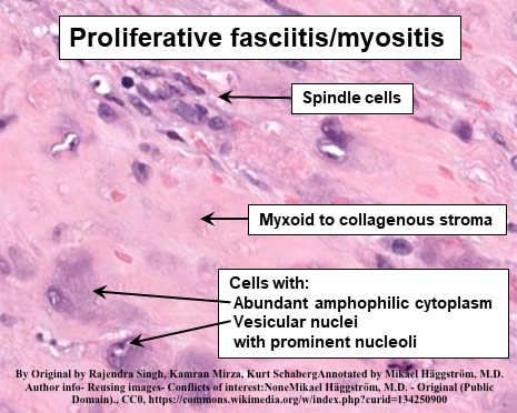 Proliferative fasciitis + Proliferative myositis  

• Former occurs subcutaneously often upper extremity; latter in skeletal muscle often trunk 
• Grow rapidly+in middle-aged adults 
•🔬both have large ganglion-like cells+plump (myo)fibroblasts
• Rarer than nodular fasciitis