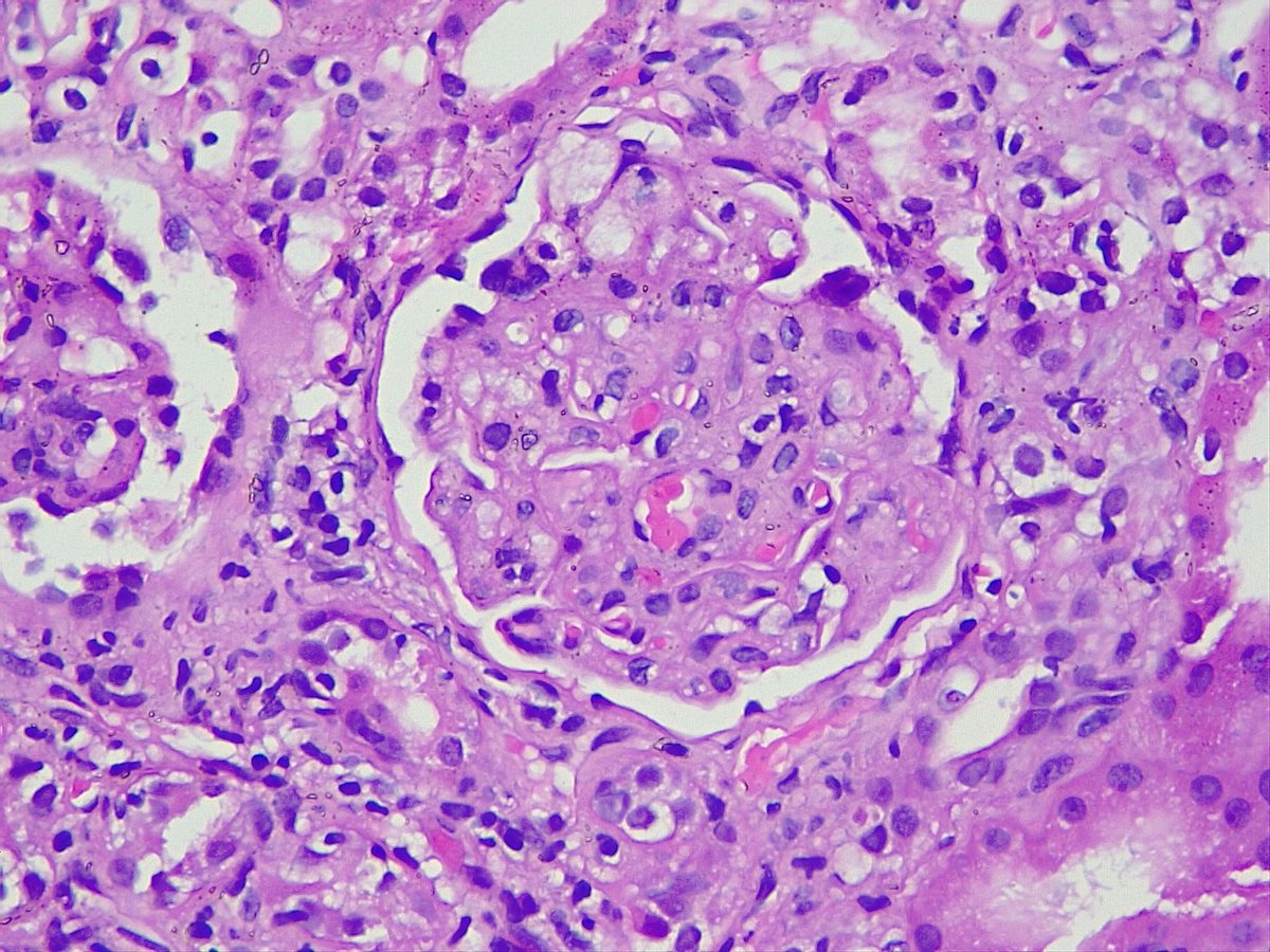 sudhirpath's tweet photo. Glomerular foam cells occluding the capillary loops (Bloodless glomeruli) in a case of Acute CNI toxicity #renalpathology #CNItoxicity #isometricvacuolization
@draalok @RitambhraN @vinaypush @JZRenalPath
@Renalpathsoc https://t.co/hOQmMfn8pL