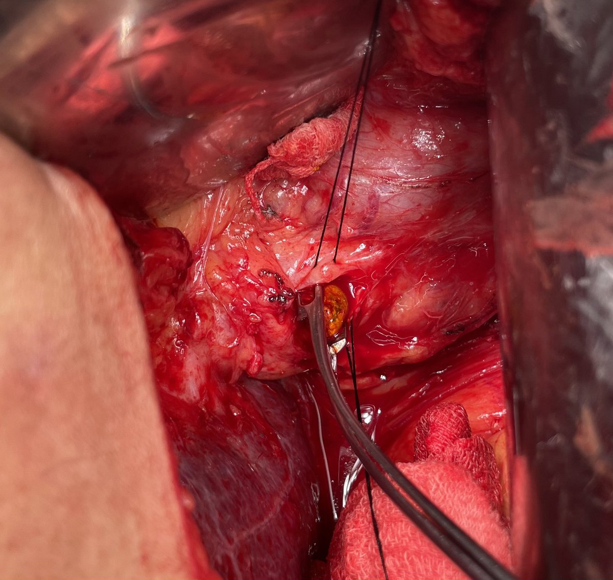 DrJAVazquez's tweet photo. Como hace mucho tiempo. Litiasis residual de colédoco y CEPRE fallida. Exploración de vía biliar abierta. 
#SoMe4Surgery #SoME4IQLatAm #surgicalmentor https://t.co/R6eDgfZDJk