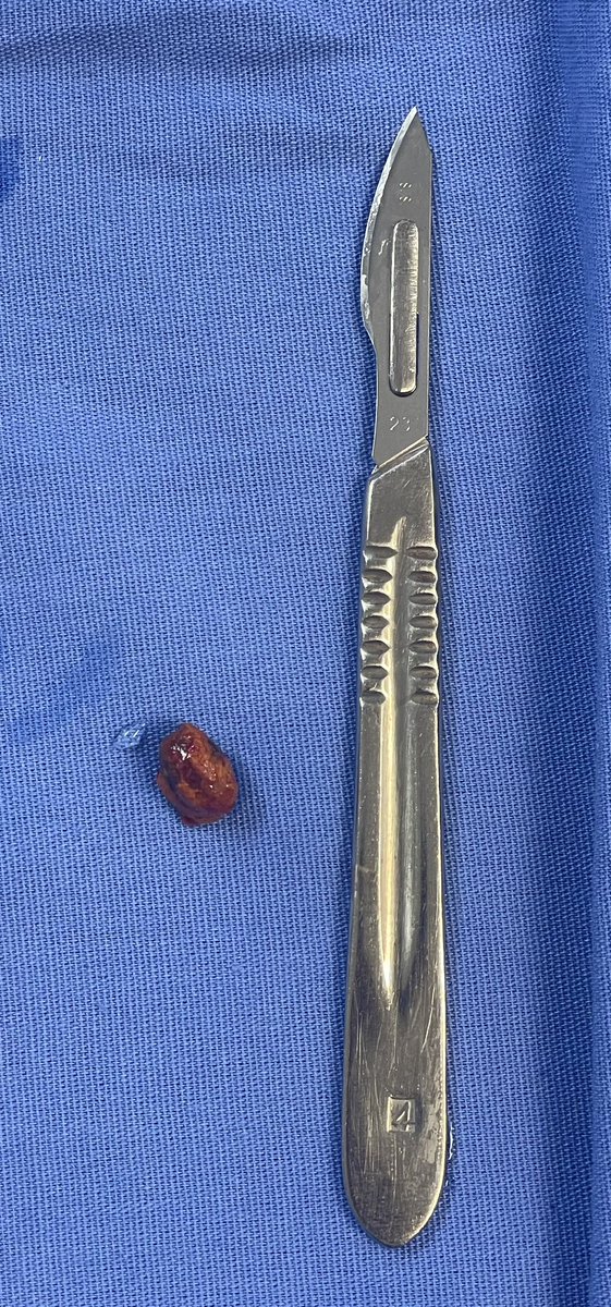 DrJAVazquez's tweet photo. Como hace mucho tiempo. Litiasis residual de colédoco y CEPRE fallida. Exploración de vía biliar abierta. 
#SoMe4Surgery #SoME4IQLatAm #surgicalmentor https://t.co/R6eDgfZDJk
