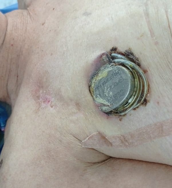 Así terminan los marcapasos implantados por los prestadores externos del IESS, para que los resuelva el HECAM. <a href="/IESSec/">IESS</a> <a href="/HCAM_IESS/">Hospital Carlos Andrade Marín</a>