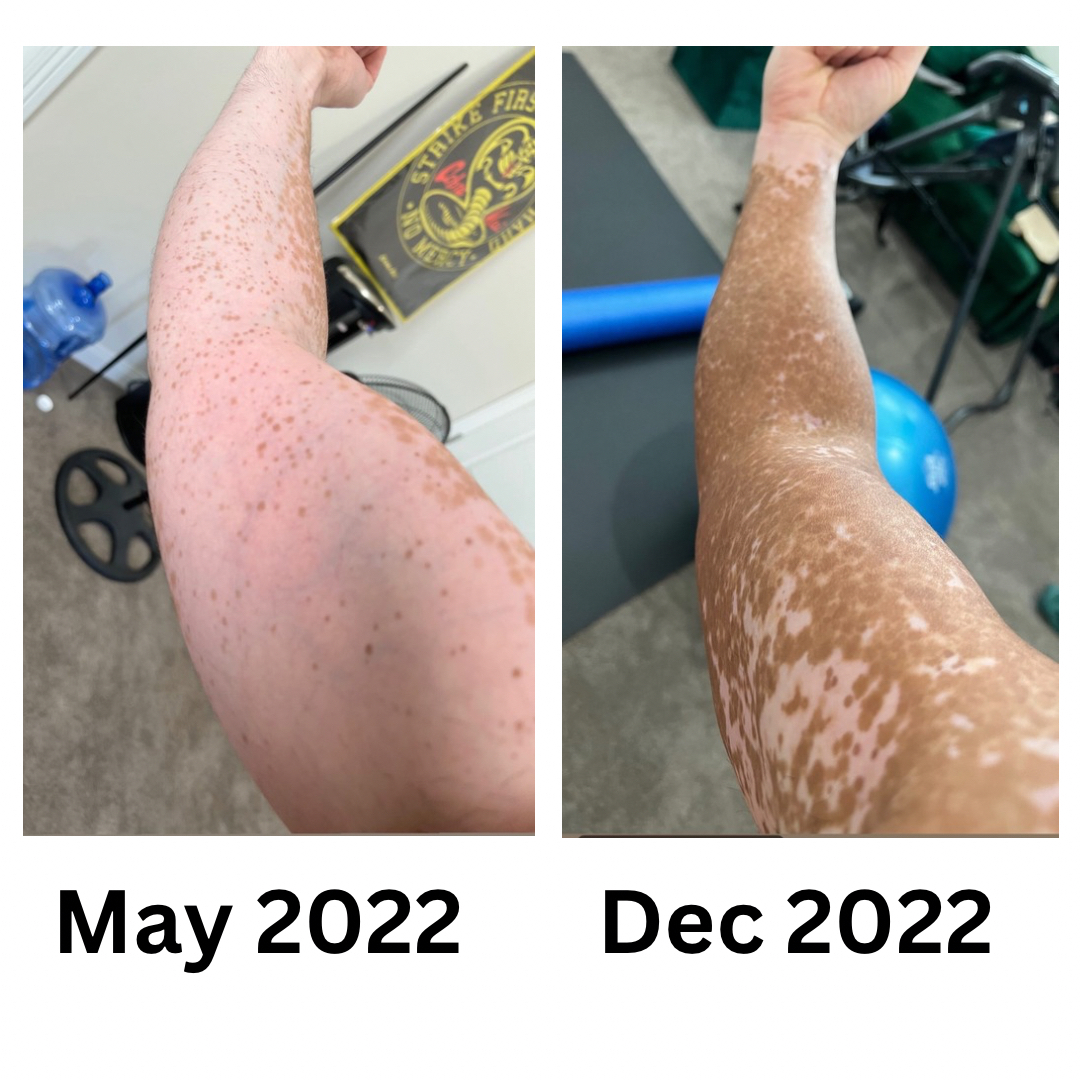 VitiligoCoach's tweet photo. How I Recovered 85% of My Pigment Back From Vitiligo Naturally in 6 Months Without Using Rx Creams

Hi my name is Amir and I've had vitiligo since I was 12.

It started off as a white patch on my finger and throughout the past 20 years, it completely took over my body.

I tried the conventional methods of recovering from my vitiligo by seeing doctors - they offered me topical steroid creams and UVB light therapy.

Unfortunately those therapies didn't work for me, and my vitiligo began to spread more and more.

By the time I was 29, I was almost completely depigmented.

I spent all my 20s trying to hide it through tanning sprays, wearing long sleeved clothes, and even make up.

I was living in constant shame of my appearance and feeling isolated from everyone else.

It impacted my emotional health so much that I had problems dating - I thought I'd be single without a partner for the rest of my life.

I gave up hope in trying to treat this condition, and eventually got tired of masking my vitiligo.

I had accepted I'd be mostly albino, and I finally for once found some level of peace within myself.

Around age 32, I decided to become a holistic health practitioner because I wanted to achieve a superior level of health from within.

If I wasn't happy from the outside, I definitely wanted to "feel" my best internally.

When I started my school and began applying the holistic health principles I learned, the most shocking thing happened ..

I noticed freckles of pigment appearing all across my body!

My skin was repigmenting at an incredible speed, the likes I've never seen before.

It looked weird, and I preferred to stay all white at this point, but my intuition told me to keep going.

I was extremely curious to see how much color I could recover on my skin ..

Within 6 months of applying the holistic health principles I learned, I had regained 85% of my color back! 

(See the attached before and after photos).

I couldn't believe that I had accidentally found a way to recover from vitiligo naturally (all while without using any prescription creams or therapy).

After I graduated from school and became a certified holistic health practitioner, I decided I wanted to help others with vitiligo recover from this condition.

My life changed so much within those years, even beyond just recovering my color back.

I gained my confidence back, and felt great about myself (both my appearance and who I am).

Shortly after, I ended up meeting a beautiful woman who I've been in an amazing relationship with.

Even though some of my vitiligo remains - she fully loves and accepts me regardless.

She even finds my remaining spots sexy 😅

The reason I share all this is because I want to provide hope for anyone that still struggles with vitiligo.

It can be reversed, maybe not completely, but enough for you to feel good in your skin and feel great inside and out!

I'll be creating content here to share what I did during those 6 months to recover - so follow me here on X to learn how.

If you're interested in learning more about my holistic health services, I offer private 1:1 coaching to help those with vitiligo recover their pigment back naturally. 

Just reply here in this thread with the word "Hope" and I will DM you with more information ☺️