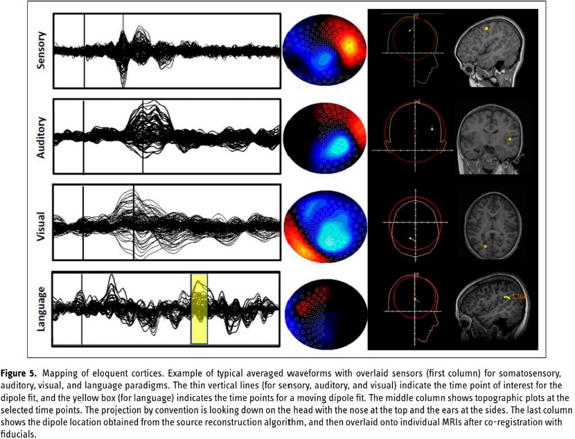 MUST READ Image-rich expert review from Boston Children’s and SickKids:
Magnetoencephalography for the pediatric population, indications, acquisition and interpretation for the clinician journals.sagepub.com/doi/10.1177/19…