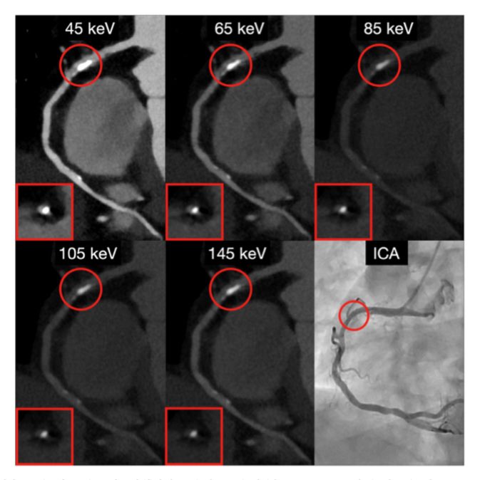 Alkadhi (@alkadhi_rad) on Twitter photo Considerable effect of monoenergetic level on calcified coronary stenosis quantification with #photoncounting #yesCCT
See our new work: shorturl.at/UAGRU <a href="/journalCCT/">Journal of Cardiovascular CT</a>
Thanks for collaboration with CCM
<a href="/RadiologieUSZ/">Radiologie USZ</a> <a href="/CardioZurich/">Cardiology USZ</a> <a href="/rmanka_/">Robert Manka</a> <a href="/MatthEberhard/">Matthias Eberhard</a> <a href="/mergen_v/">Mergen Victor</a> Considerable effect of monoenergetic level on calcified coronary stenosis quantification with #photoncounting #yesCCT
See our new work: shorturl.at/UAGRU <a href="/journalCCT/">Journal of Cardiovascular CT</a>
Thanks for collaboration with CCM
<a href="/RadiologieUSZ/">Radiologie USZ</a> <a href="/CardioZurich/">Cardiology USZ</a> <a href="/rmanka_/">Robert Manka</a> <a href="/MatthEberhard/">Matthias Eberhard</a> <a href="/mergen_v/">Mergen Victor</a>