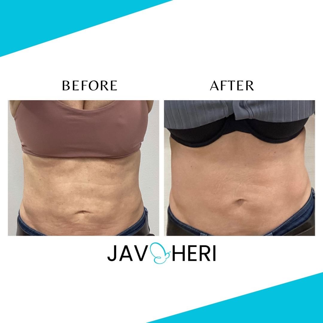 Shahin Javaheri, MD - Plastic Surgeon tweet media