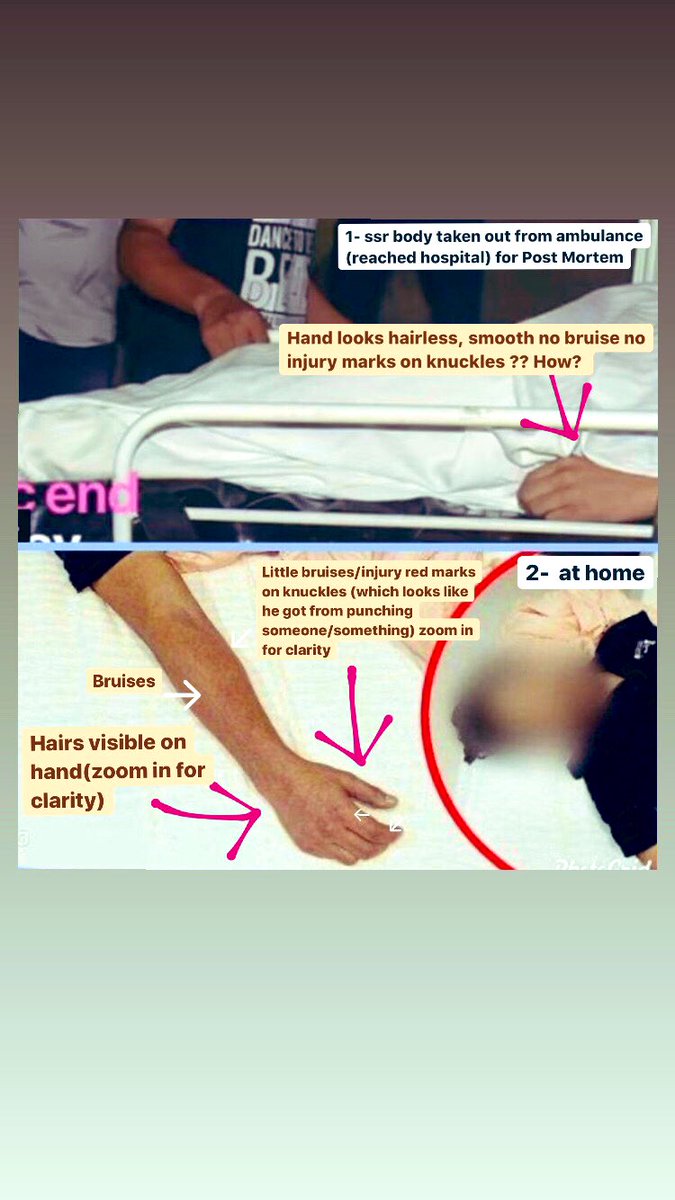 So many injuries marks was found in SSR's body.. 

Yet CBI is confuse between suicide and murder?? 

#JusticeForSushantSinghRajput 
#BoycottBollywoodcompletelyforever 

4years Of Injustice To Sushant