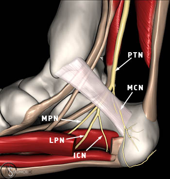 Today: Yet another patient with LOTS of years of plantar heel pain. Very tender on the plantar fascia origin, but lo and behold when you can track the tenderness medially up along Baxter's nerve (ICN). Even +scratch collapse test, first time I tried it on this entrapment.