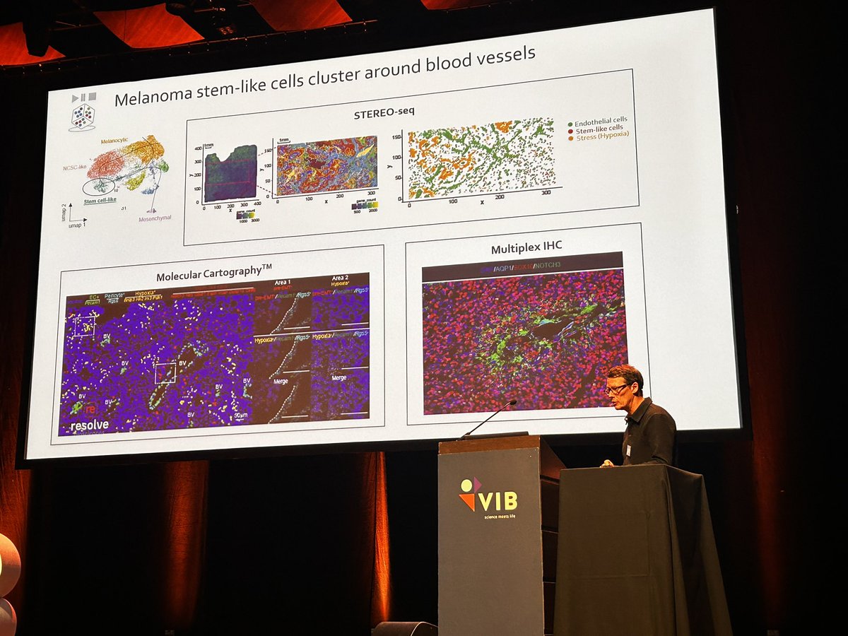 GigaScience's tweet image. J-C presenting lots of nice data showcasing @ST_Omics tech, such as this Stereo-seq data showing stem-like cells clustering around blood vessels in melanoma #SpatialOmics24