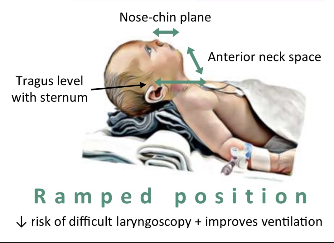 “Belly above the chin? Put a tube in!” 

<a href="/Admckdoc/">Andrew Mckechnie</a> highlighting clear benefits of effective pre-oxygenation and ramping strategies to improve apnoeic time 🕰️ 
(as per SOBA paediatric guidance) <a href="/SOBAuk/">SOBA</a> <a href="/APAGBI/">APAGBI</a> #childhoodobesity

sobauk.co.uk/_files/ugd/373…
