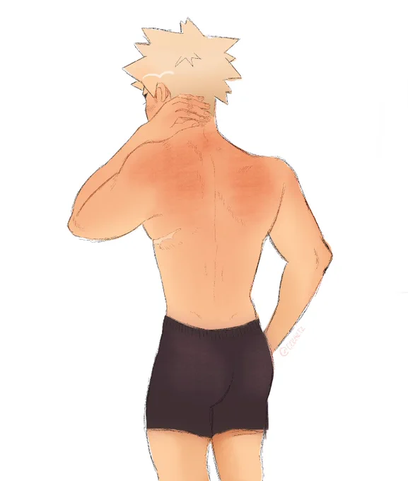 someone forgot sunscreen #krbkdk