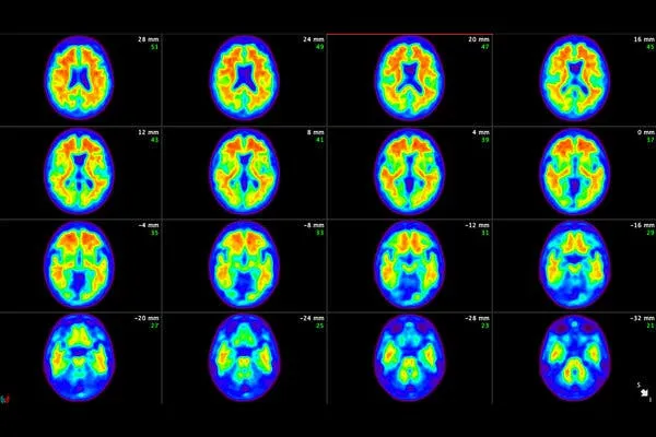 packyM's tweet image. 5 deaf kids hear with gene therapy.
Scientists discover cancer-spread gene.
FDA panel approves new Alzheimer's drug.
Bill Gates breaks ground on TerraPower nuclear plant.
IT'S TIME TO BUILD a Solugen Bioforge with $213.5M from DOE.
+How to jhana.

What a week for the optimists.