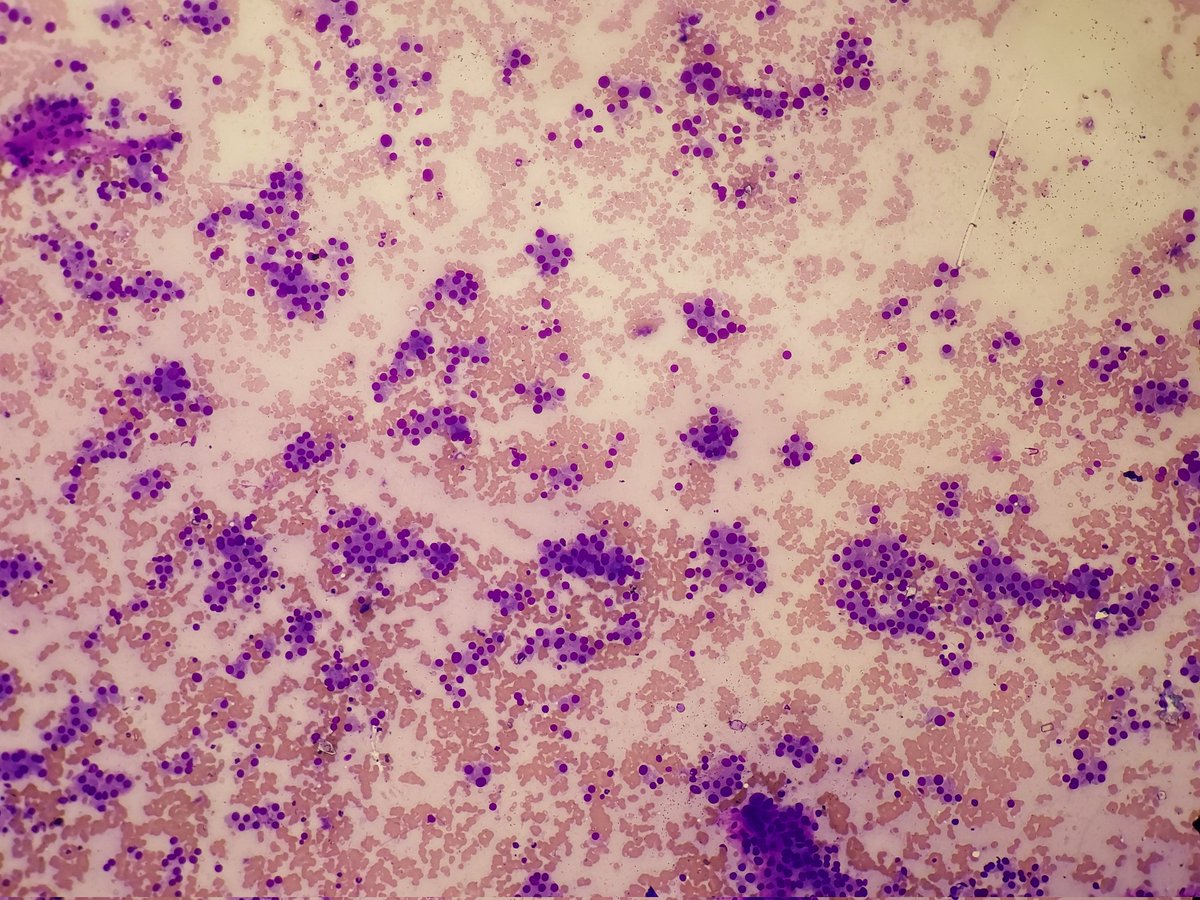 padmapathology1's tweet photo. #CytoMacroMicroCorrelation 
#pathology #pathresidents #endopath 
Oncocytic carcinoma of thyroid 
Vascular invasion and capsular invasion
#pathclassic 
#cytopath image courtesy Dr. Hema Kini and Dr. Mounika https://t.co/7WWvubNjs8