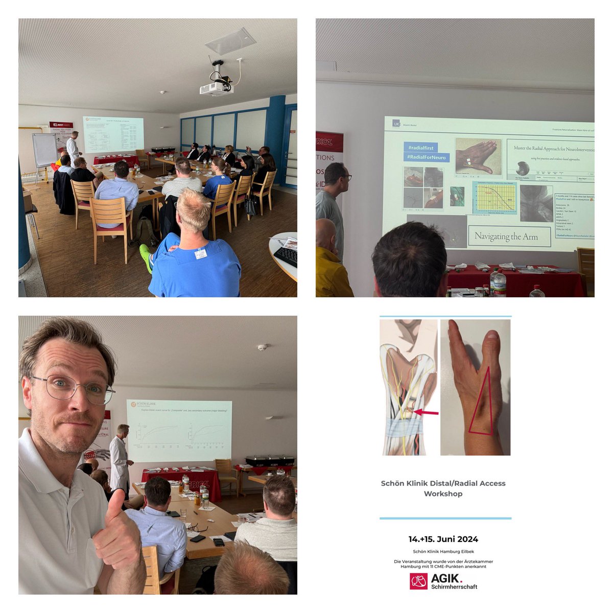 Erik Rafflenbeul (@kardiologiehh) on Twitter photo The โnewโ #RadialFirst at
Schรถn Klinik Gruppe Hamburg
#DistalRadial #dTRA Workshop
#LearningTogether:
#InterventionalCardiologists
meet
#InterventionalRadiologists
Thanks for the collaboration with Dr Maxim Bester from <a href="/UKEHamburg/">UKE Hamburg</a> for the talk on #TRA in #INR
Thanks to The โnewโ #RadialFirst at
Schรถn Klinik Gruppe Hamburg
#DistalRadial #dTRA Workshop
#LearningTogether:
#InterventionalCardiologists
meet
#InterventionalRadiologists
Thanks for the collaboration with Dr Maxim Bester from <a href="/UKEHamburg/">UKE Hamburg</a> for the talk on #TRA in #INR
Thanks to