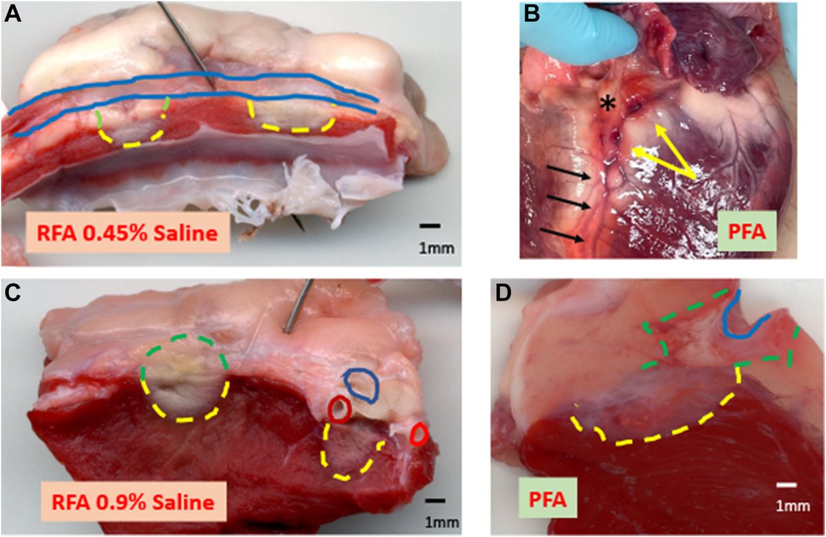 Pasquale Santangeli (@dr_santangeli) on Twitter photo Comparative Efficacy and Safety of PFA Versus RFA of Idiopathic LV Arrhythmias - PFA outperformed RFA in challenging locations like Papillary, LV summit via distal CS and direct epicardium. jacc.org/doi/10.1016/j.… Congrats to star fellow <a href="/arwayounis2/">Arwa Younis MD</a> <a href="/CleClinicHVTI/">Cleveland Clinic Heart, Vascular & Thoracic</a> <a href="/omwazni/">Oussama Wazni</a> Comparative Efficacy and Safety of PFA Versus RFA of Idiopathic LV Arrhythmias - PFA outperformed RFA in challenging locations like Papillary, LV summit via distal CS and direct epicardium. jacc.org/doi/10.1016/j.… Congrats to star fellow <a href="/arwayounis2/">Arwa Younis MD</a> <a href="/CleClinicHVTI/">Cleveland Clinic Heart, Vascular & Thoracic</a> <a href="/omwazni/">Oussama Wazni</a>