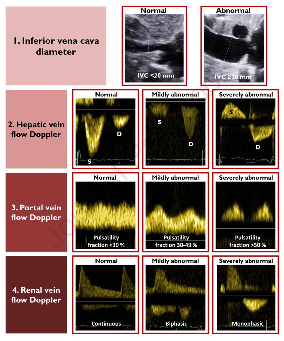 Back to #VEXUS basics:

Multi-organ venous congestion assessment by ultrasound includes inferior vena cava (IVC) diameter and pulse-wave Doppler of the hepatic, portal, and renal vein. Larger IVC and more abnormal flow patterns indicate worse venous congestion