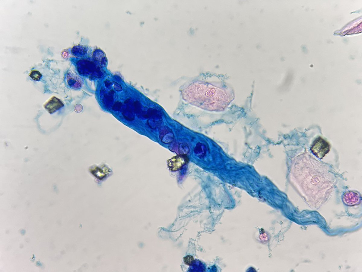QFB_Daniel's tweet photo. Cilindros de células de túbulo renal y "decoy cells". 
Paciente sin terapia inmunosupresora, hospitalizada por necrobiosis consecuencia de diabetes no controlada. 

📸 Tinción Sternheimer y Sternheimer-Malbin. https://t.co/JCfGUxLkZZ