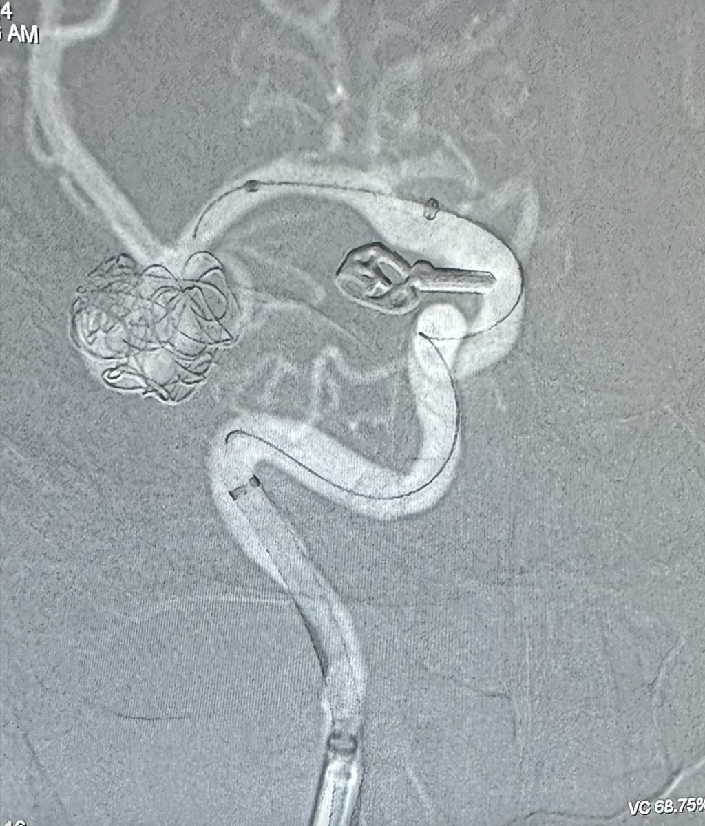 PenNeuro's tweet photo. US HCPs: #MIDWAY 62 tracking to supraclinoid ICA to support Pipeline deployment in management of previously coiled MCA bifurcation aneurysm. System supported with #NeuronMAX. Courtesy of Dr. North & Dr. McPherson!
Rx only. Risk: https://t.co/hzWEQEQmfZ Clinical results may vary https://t.co/3mkMCm5Fn2