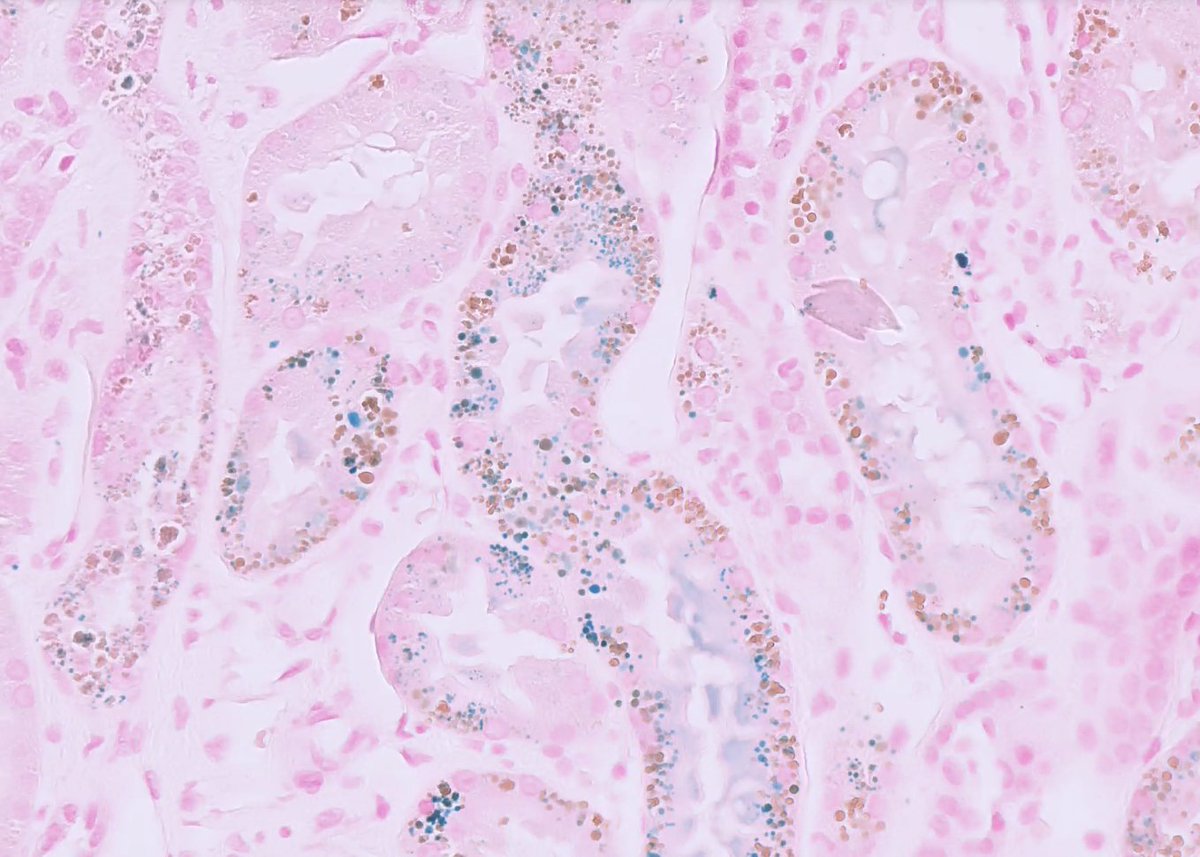 ssfarouk's tweet image. Pretty picture: pigment within tubular epithelial cells, +iron stain 

#KidneyPath #Nephrology