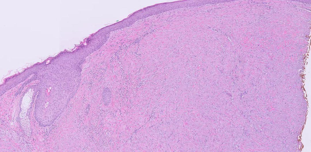 JoanaPath's tweet photo. 83y male with a lesion on his nose (scar? desmoplastic melanoma?). There's a melanocytic nest in the dermis and inflammation and foreign body reaction but there is no record of previous excisions in this location. No mitosis. I really need some advise :) @JMGardnerMD https://t.co/vvzMkReXNF